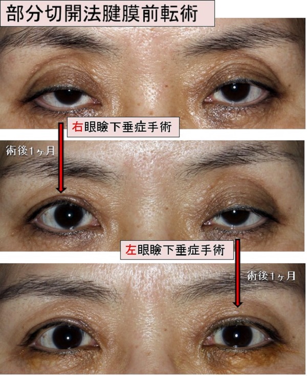 眼瞼下垂、部分切開、小切開、手術、傷目立たない、腫れない、切らない眼瞼下垂