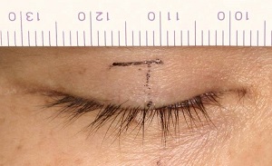 眼瞼下垂、部分切開、小切開、手術、腫れ少ない,デザイン、傷跡目立たない