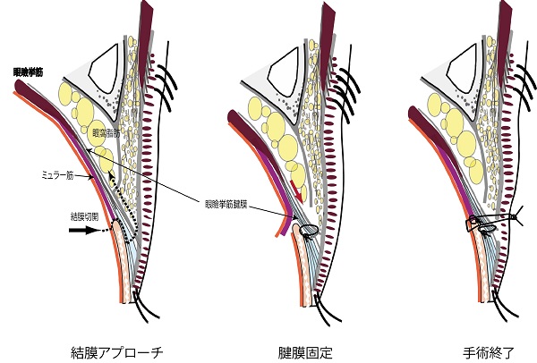 切らない眼瞼下垂,経結膜,腫れ少ない